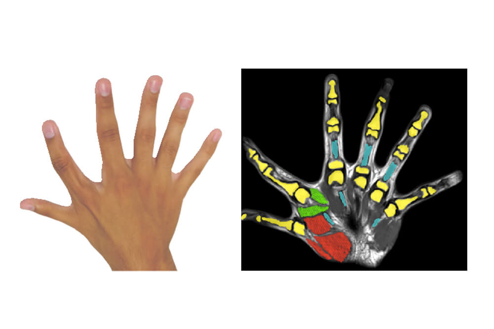 Polydactyly — person with six fingers