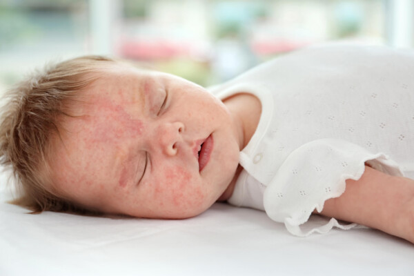 Baby with eczema or skin rash