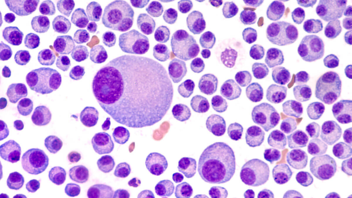 Multiple Myeloma Awareness: Bone marrow aspirate cytology of multiple myeloma, a type of bone marrow cancer of malignant plasma cells, associated with bone pain, bone  fractures and anemia.