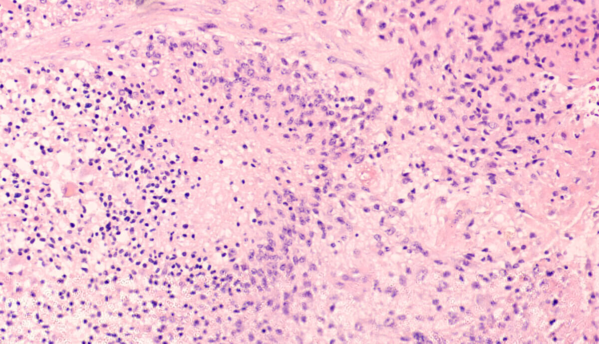 Microscopic image showing histology of a glioblastoma multiforme (GBM), a type of brain cancer.  Necrosis and vascular proliferation are diagnostic features of this high grade malignant tumor.