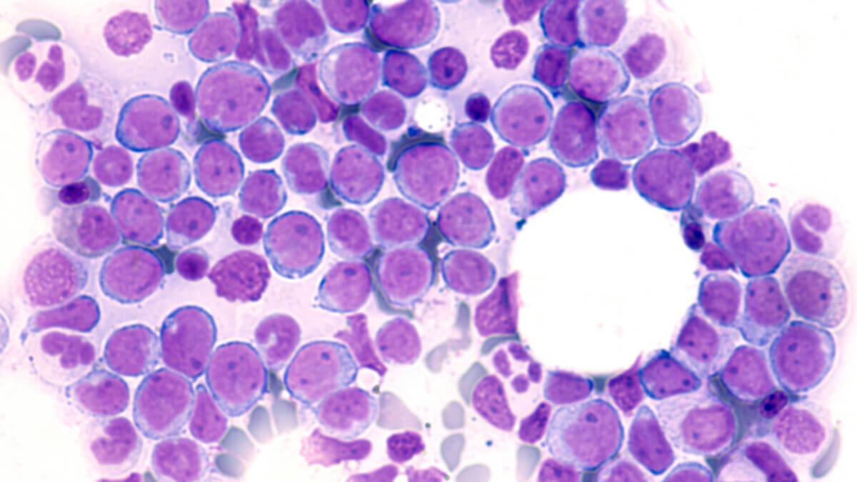 Leukemia Awareness: Photomicrograph of bone marrow aspirate showing myeloblasts of acute myeloid leukemia (AML), a cancer of white blood cells.