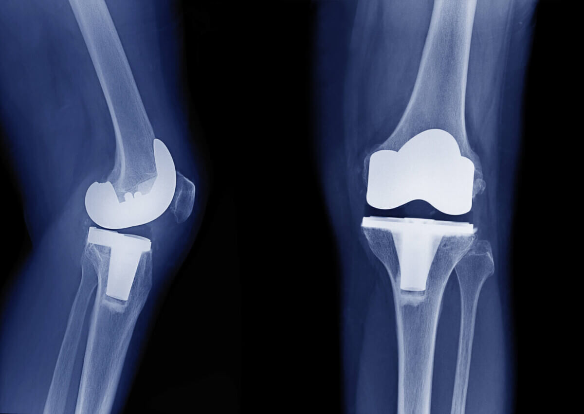 X-ray image of total knee arthroplasty / total knee replacement