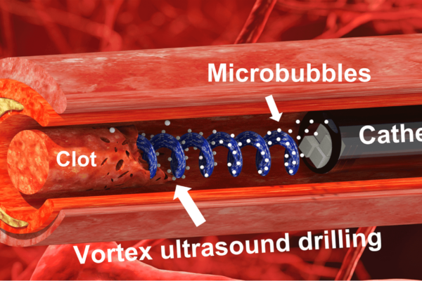 Illustration of a “vortex ultrasound” – a sort of ultrasonic tornado – to break down blood clots.