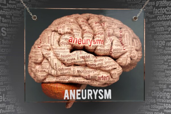 Aneurysm anatomy on a human brain