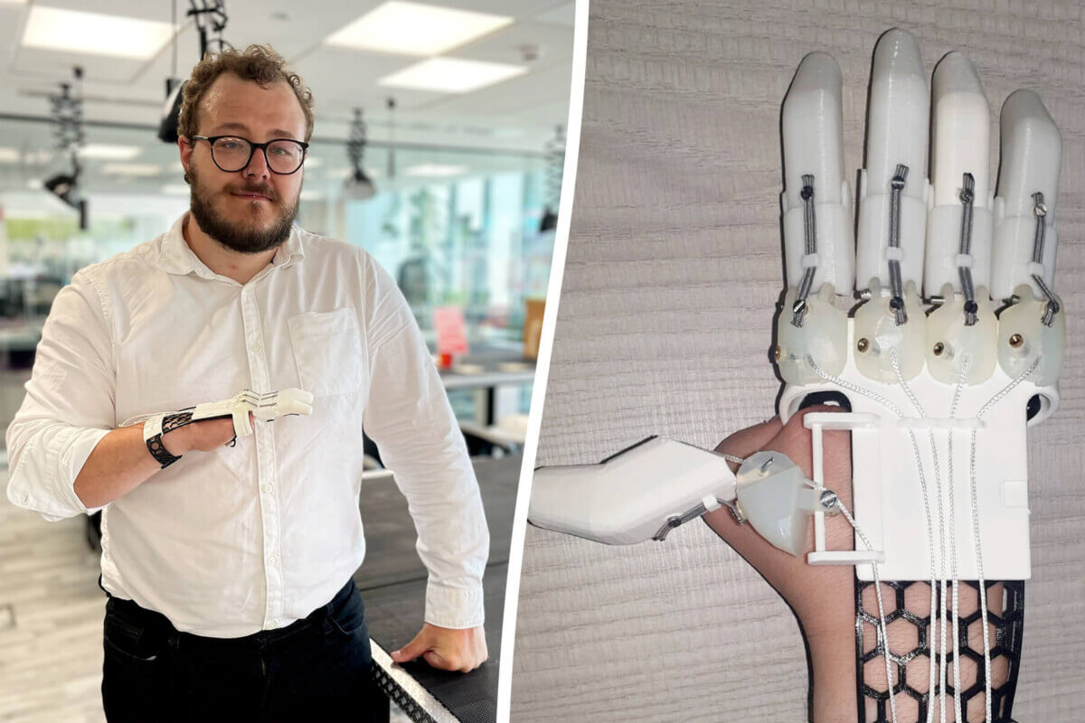 Luke Cox prosthetic hand