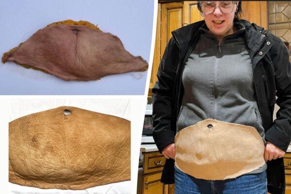 Woman who underwent extreme weight loss surgery turns her own excess skin into leather.