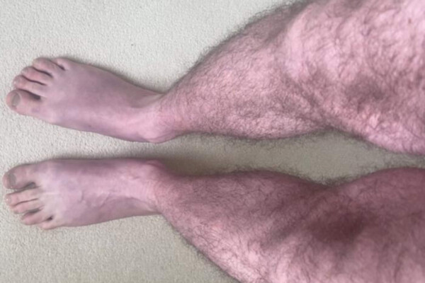 blue legs of a long covid patient