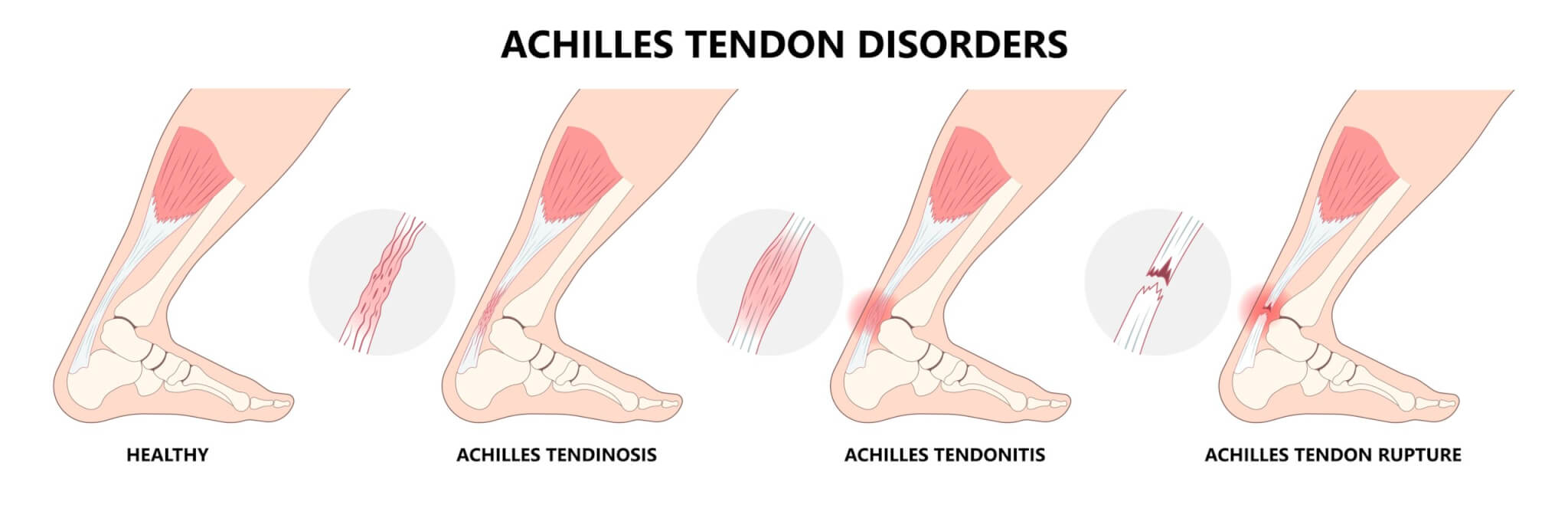 Achilles tendon injuries