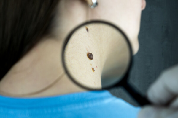 person with magnifying glass examining skin mole