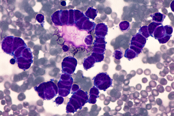 Lung Cancer Awareness: Microscopic image of pleural fluid cytology of a small cell (oat cell) carcinoma from a patient with a history of smoking, demonstrating characteristic nuclear molding.