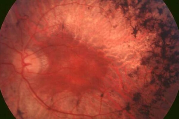 eye retinitis