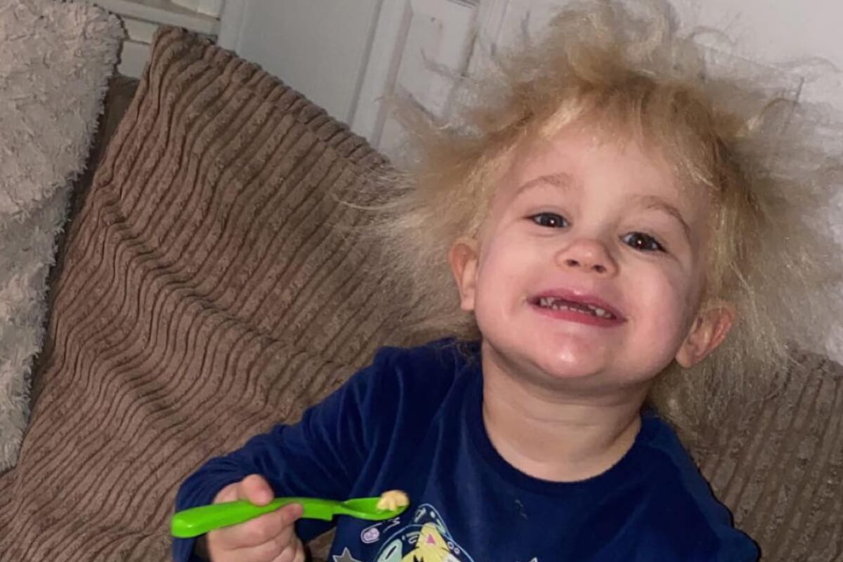 Toddler uncombable Hair Syndrome