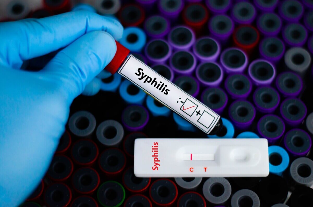 syphilis diagnostic test
