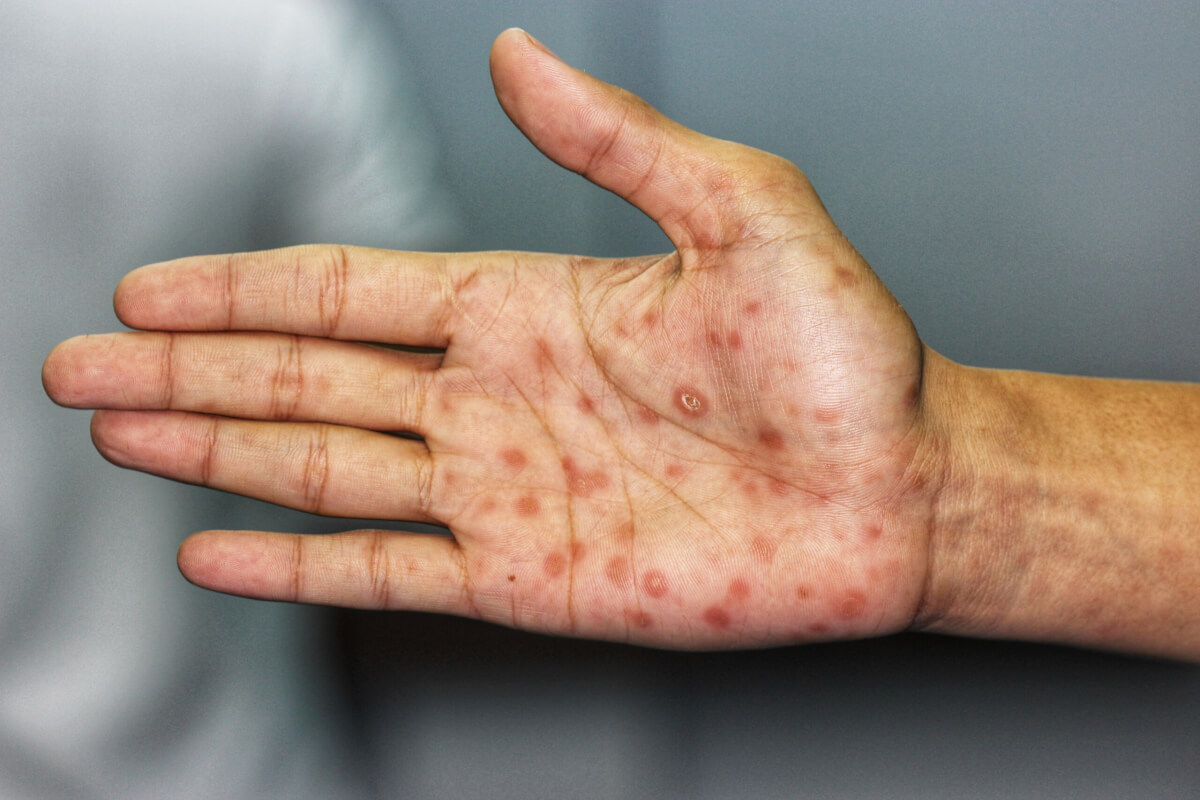 Secondary Stage Syphilis on patient's hand