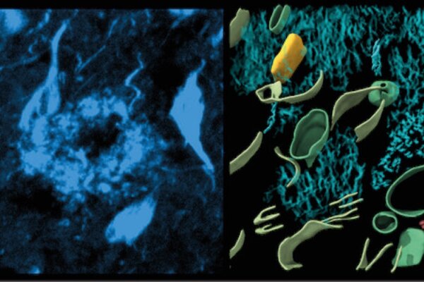 Left, fluorescence image of amyloid in cryo-preserved post-mortem human brain. Middle, 3-dimensional molecular architecture of β-amyloid plaque. Right, in-tissue structure of tau filaments within post-mortem brain.